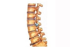 Etape de dezvoltare a osteochondrozei cervicale