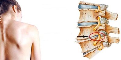 Mecanismul de dezvoltare a osteochondrozei cervicale