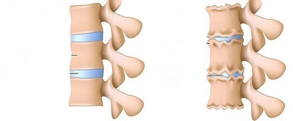 Coloană vertebrală sănătoasă și osteochondroză