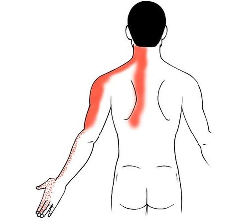 osteocondroza cervicală ca cauză a durerii în articulațiile degetelor