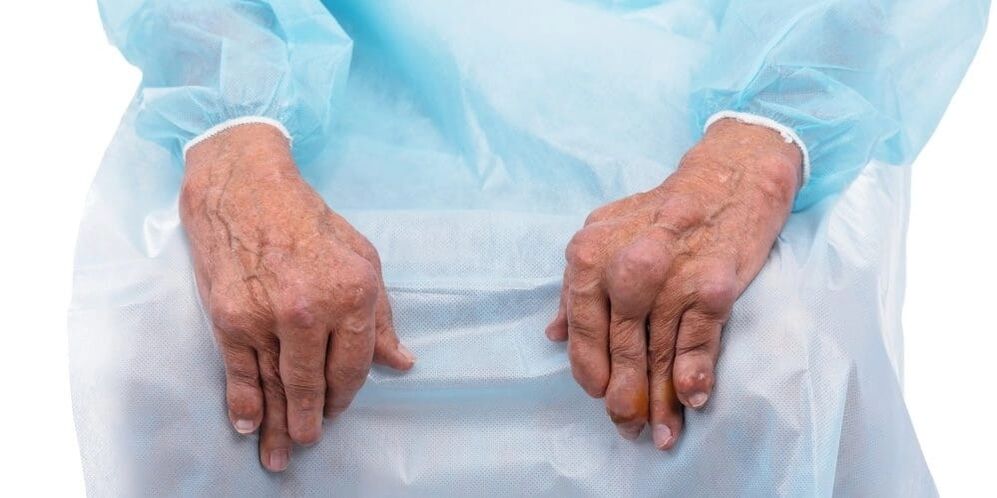 Artrita infectioasa este o boala cu dureri constante si modificari la nivelul articulatiilor degetelor.