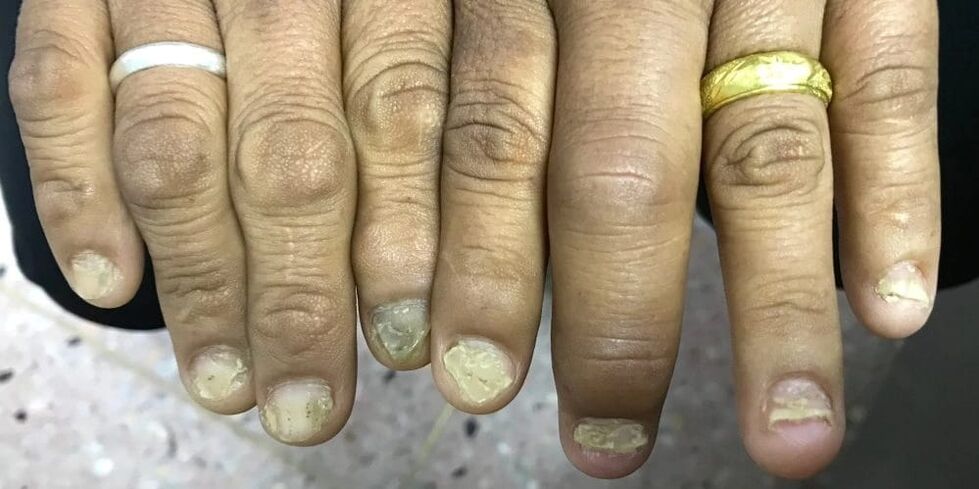 Umflarea degetelor și deformarea plăcii unghiei pot indica dezvoltarea artritei psoriazice