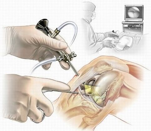 artroscopia genunchiului pentru osteoartrita